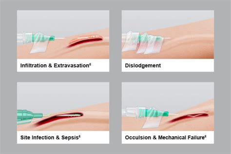 Difficult IV access