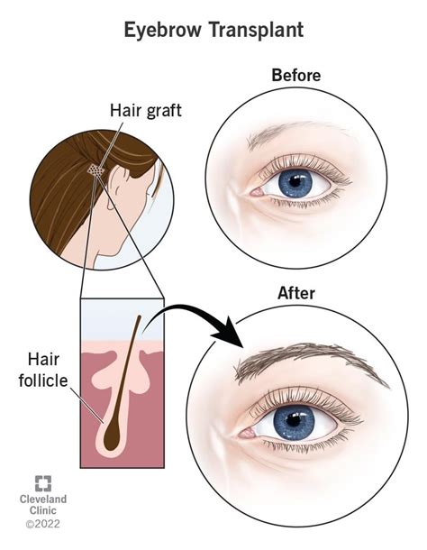 Eyebrow Transplant: What It Is, Surgery, Recovery & Results