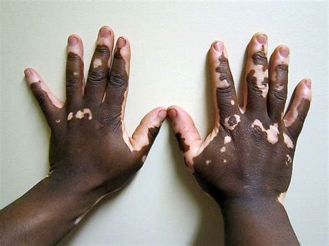 Vitiligo: 10 Causes of Vitiligo