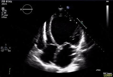 Enlarged Heart – Explained By A Cardiologist • MyHeart