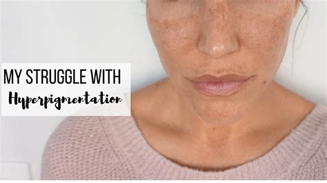 Before & After: Laser Treatments For Hyperpigmentation - Babeskills