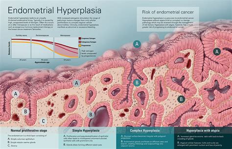 Hiperplasia Endometrial