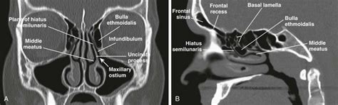 Inferior Meatus Radiograph