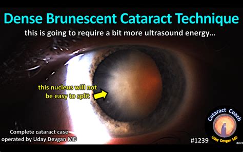 brunescent cataract – Cataract Coach