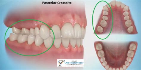 What Is A Crossbite? Signs, Effects, and Treatment - Miami Orthodontist ...