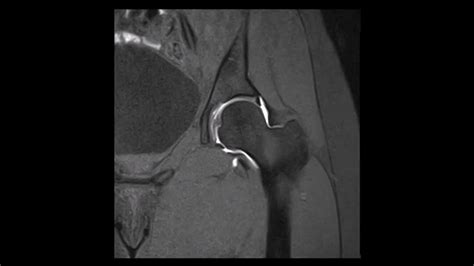 Hip MRI: Arthrogram (Contrast in Joint) Normal (No Pathology) - YouTube