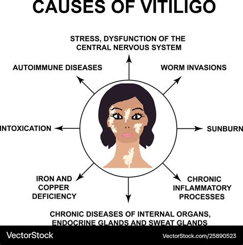 Causes vitiligo world vitiligo day Royalty Free Vector Image