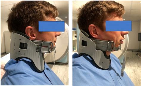 Lubo cervical collar with jaw-thrust mechanism | Download Scientific ...