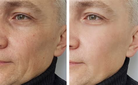 Cosmetic Fillers | Advanced Dermatology of the Midlands | Omaha