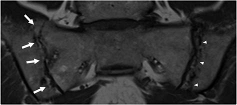 Parallel Line Sign—A New MRI Sign Associated With Chronic Sacroiliitis ...