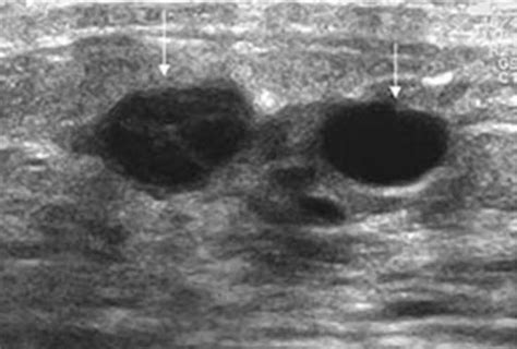 Breast Ultrasound Cancer Vs Benign Canceroz