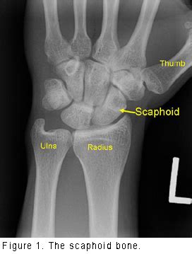 Scaphoid (Wrist Bone) Fracture - Orthopedic Specialists of Seattle