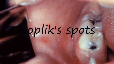 How to Pronounce Koplik's spots? - YouTube