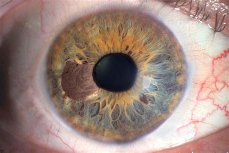 Tumors | Optometry Today