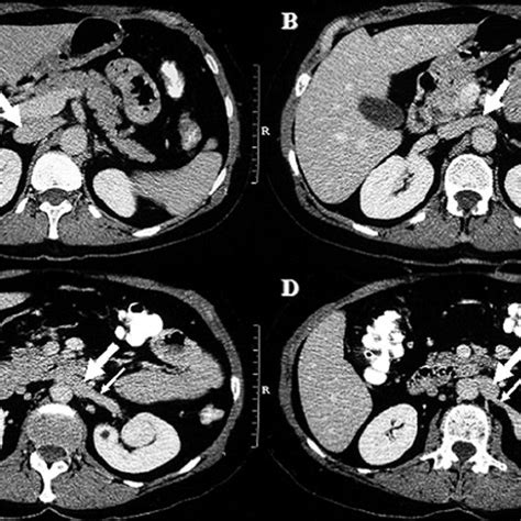 Intraoperative image during left laparoscopic radical nephrectomy. View ...