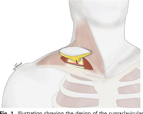 Supraclavicular lymph nodes - padjord