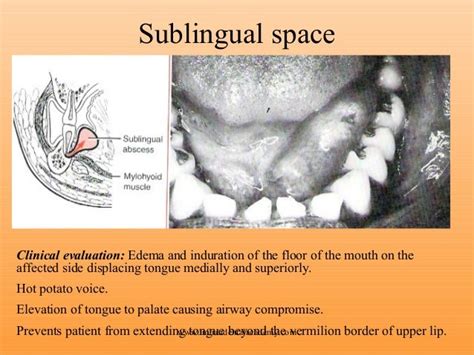 Space infection 2 /certified fixed orthodontic courses by Indian dent…