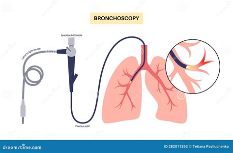 Bronchoscopy Procedure Concept Stock Vector - Illustration of fibrosis ...