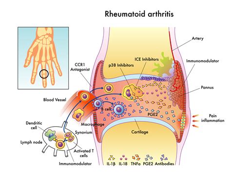 Rheumatoid Arthritis | The Pain Relief Clinic