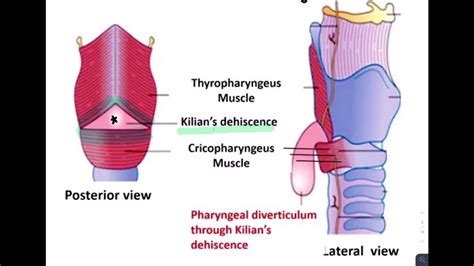 ESOPHAGEAL DIVERTICULUM - YouTube