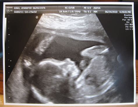 Baby ultrasound pics 21 weeks Idea | hostalelportalico