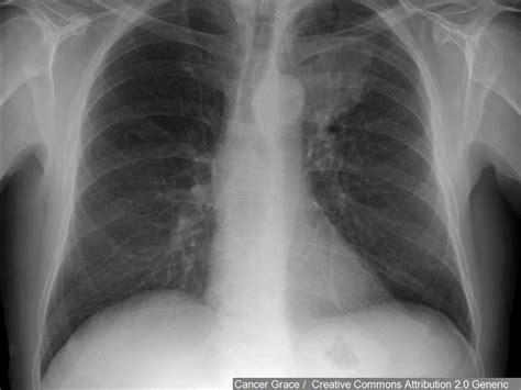 PRMC on Diagnosing Lung Lesions - Friday, November 13, 2015 - DelmarvaLife