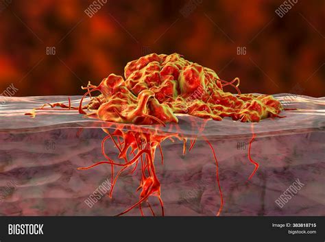 Invasive Cancer Growth Image & Photo (Free Trial) | Bigstock