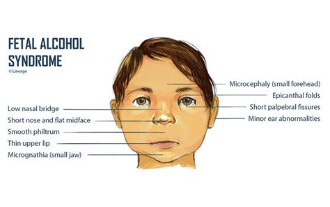 Flat Nasal Bridge And Epicanthal Folds : Flat Nasal Bridge And ...