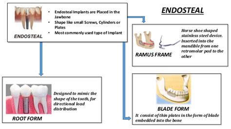 Types Of Implants - Dental News Network