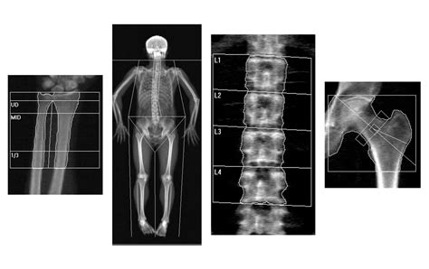 DXA Scan - Arthritis and Osteoporosis Associates