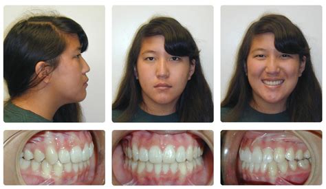 Before And After Braces Overbite