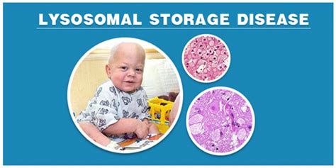 Lysosomal Storage Disease -Types, Symptoms, Causes and its Treatment