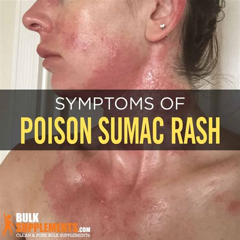 Poison Sumac Rash