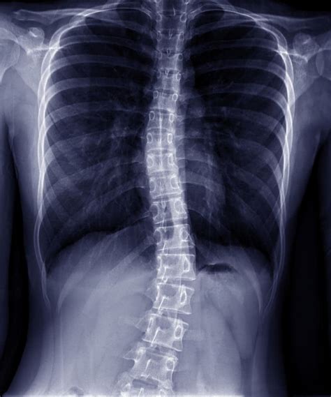 Lumbar Scoliosis Surgery