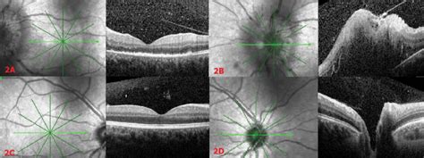 Optical coherence tomography (OCT) scan of the left eye depicting ...