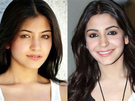 Chatter Busy: Anushka Sharma Plastic Surgery