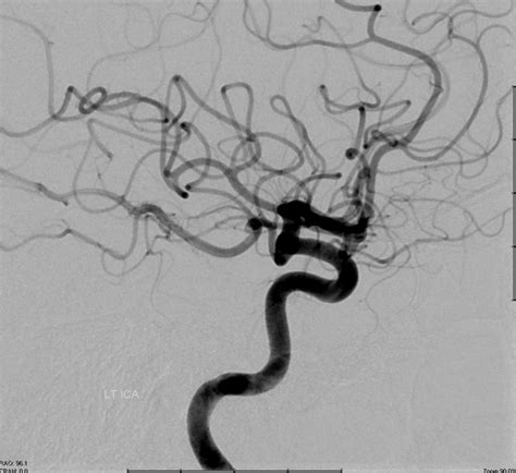 Internal Carotid Artery and Its Aneurysms | neuroangio.org