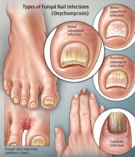 Foot fungus types pictures - Awesome Nail