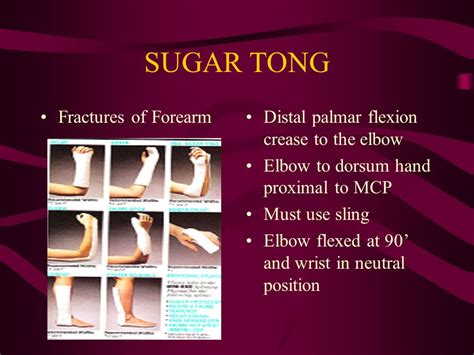 Reverse Sugar Tong Splint