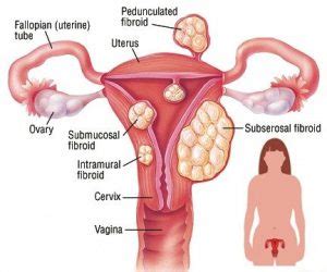 The Best Fibroid Removal Kit – Sky Natural Health