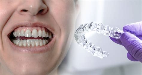 Invisalign Attachments: What Are They and How Do They Work?