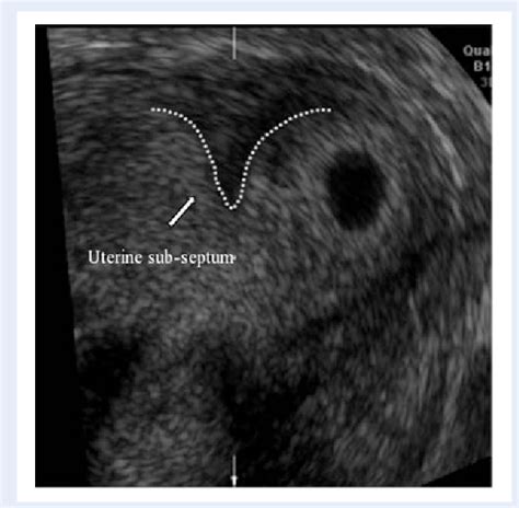 [PDF] The pregnancy outcome in women with incidental diagnosis of ...