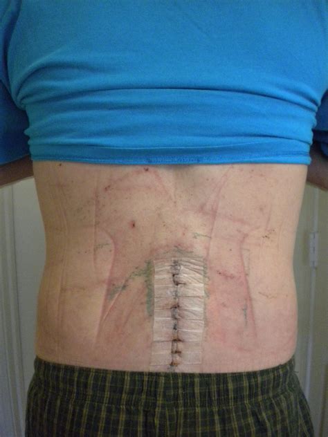 Photo of Spinal Fusion Incision - L4 & L5 | Spinal fusion, Spinal ...