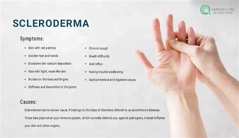 Scleroderma Symptoms, Types, and Available Treatment - Social Social ...