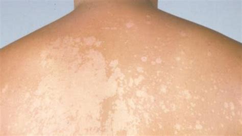 White spots on the skin | Dangerous? (with pictures)