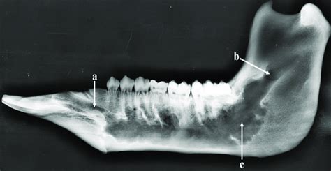 Mandibular Foramen Radiograph