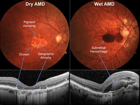 AMD Or Age-Related Macular Degeneration: Researchers Identify ...