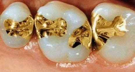 Gold Inlays and Onlays | DMS Dentistry