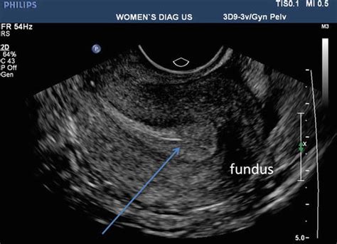 Ultrasound Imaging of Gynaecologic Organs | Radiology Key