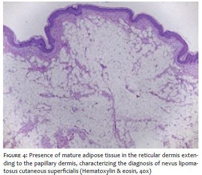 Surgical & Cosmetic Dermatology | Nevus lipomatosus cutaneous ...